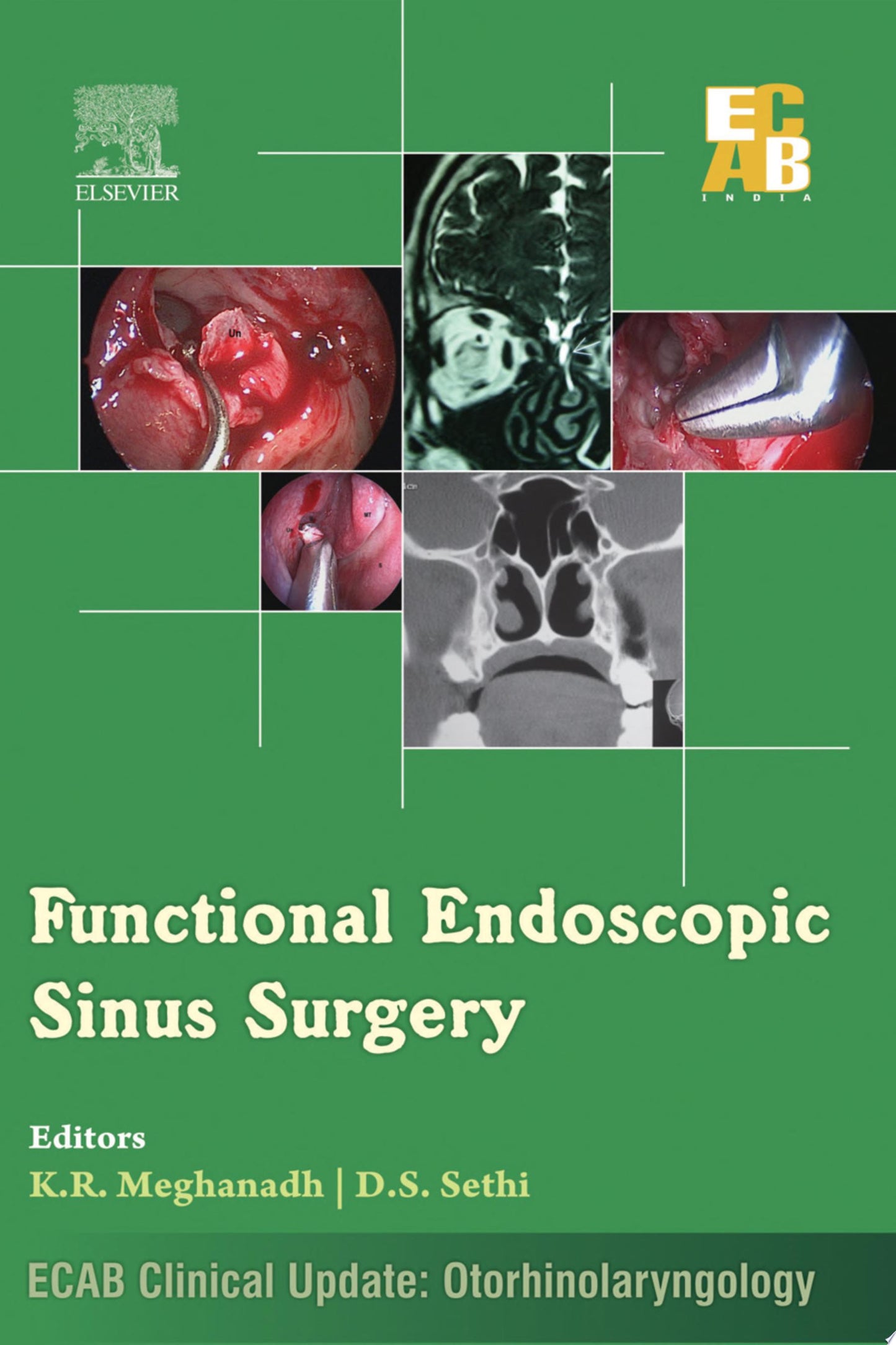 Functional Endoscopic Sinus Surgery