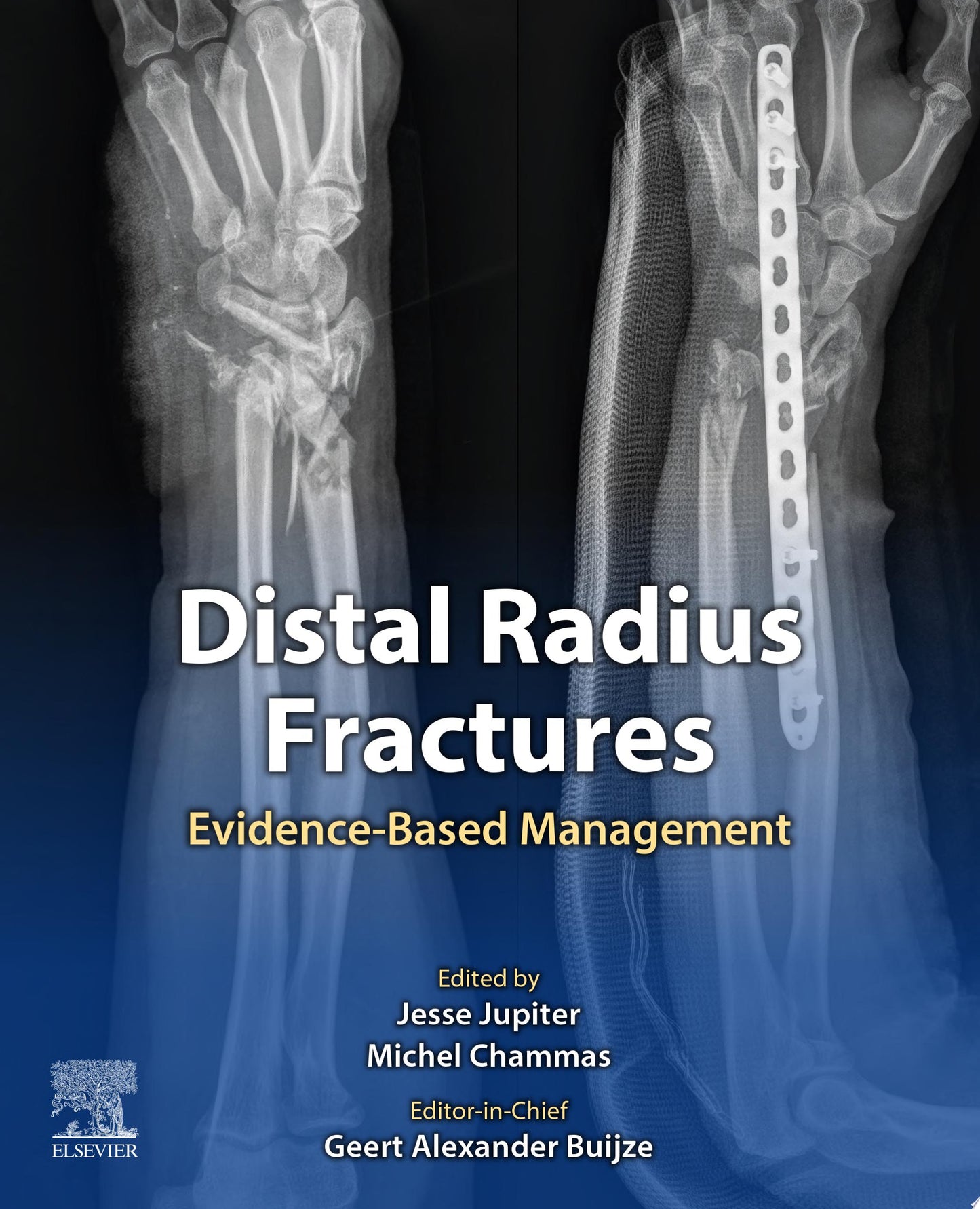 Distal Radius Fractures: Evidence-Based Management