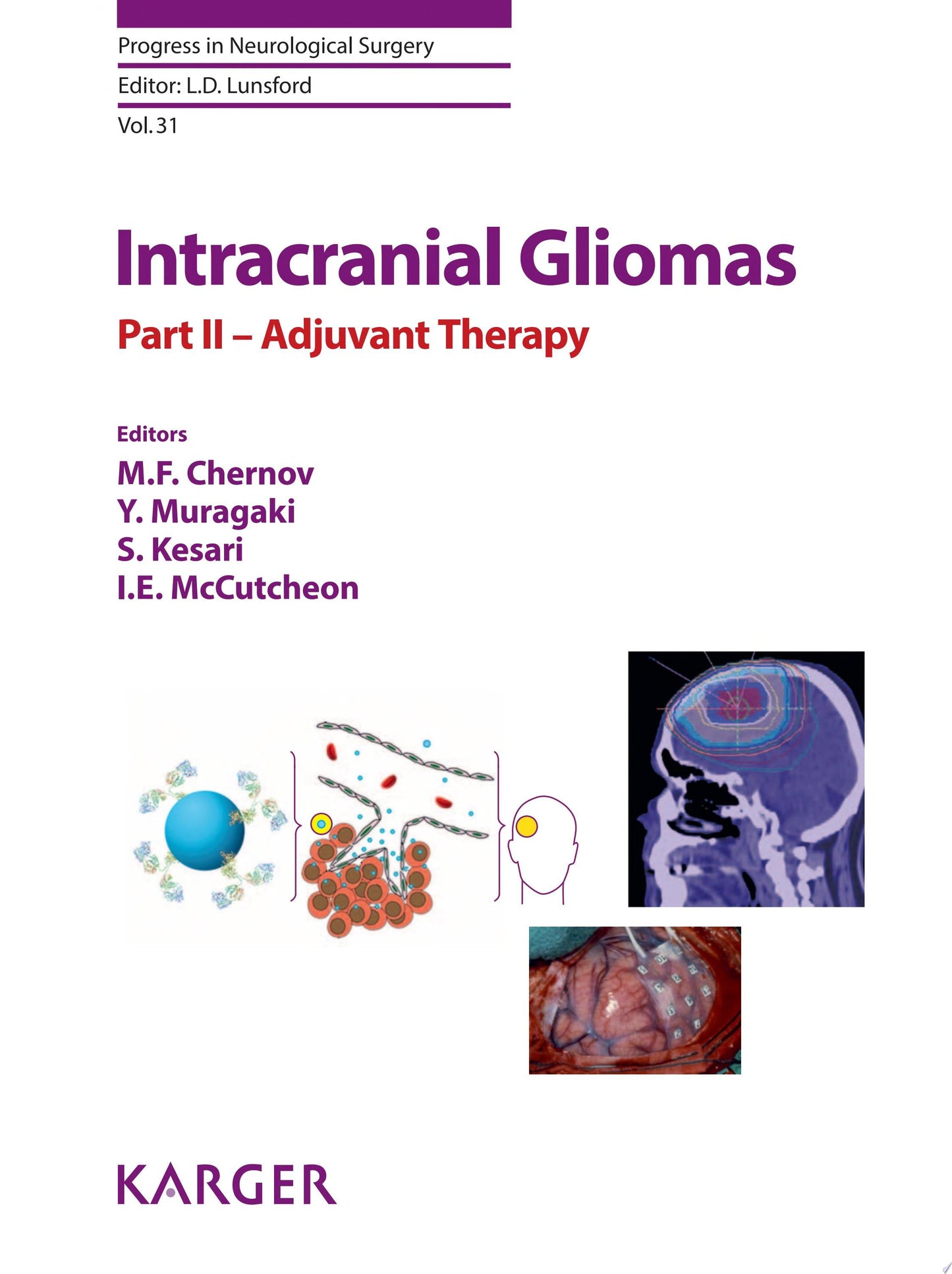 Intracranial Gliomas Part II – Adjuvant Therapy 1st Edition
