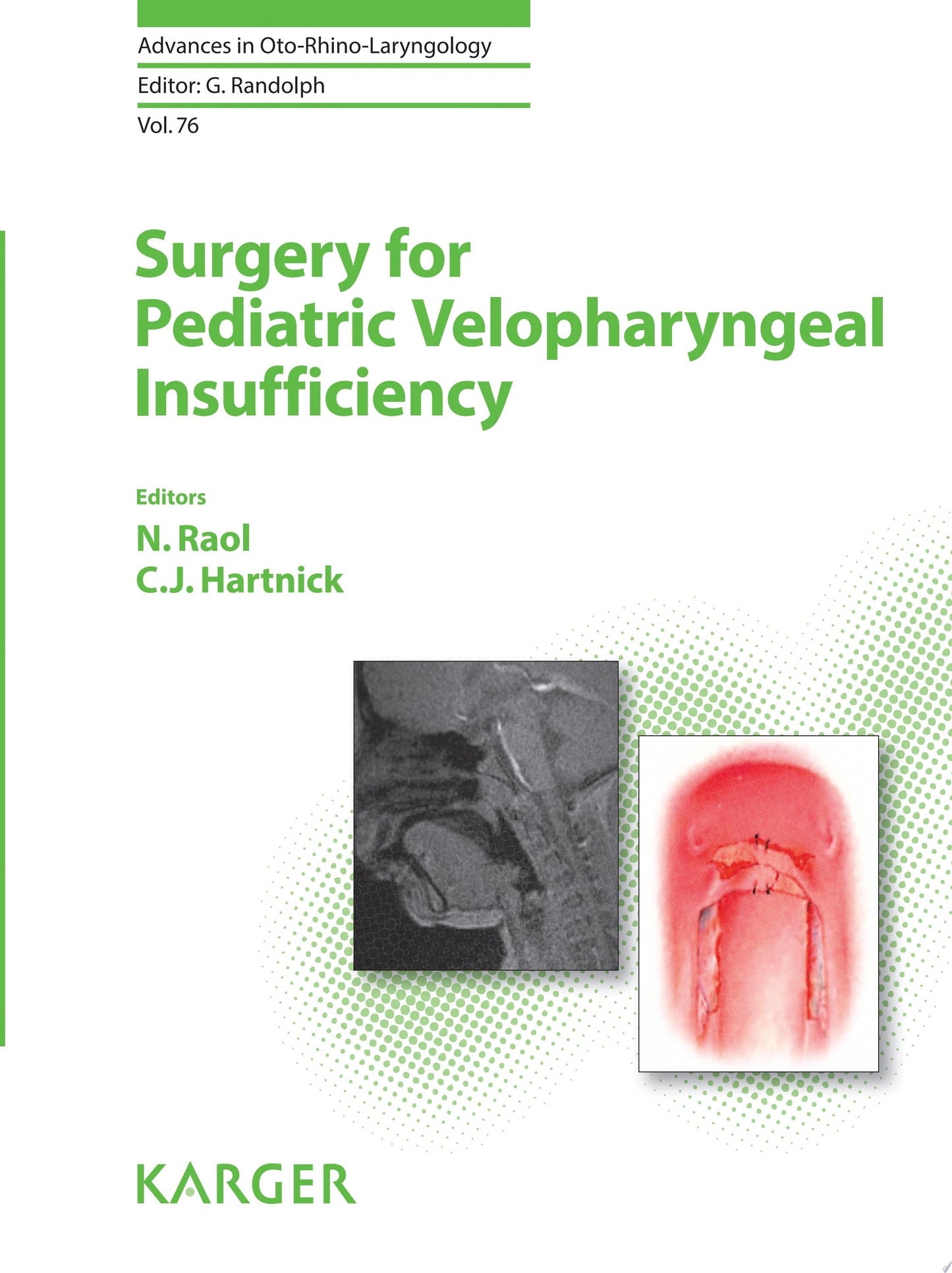 Surgery for Pediatric Velopharyngeal Insufficiency