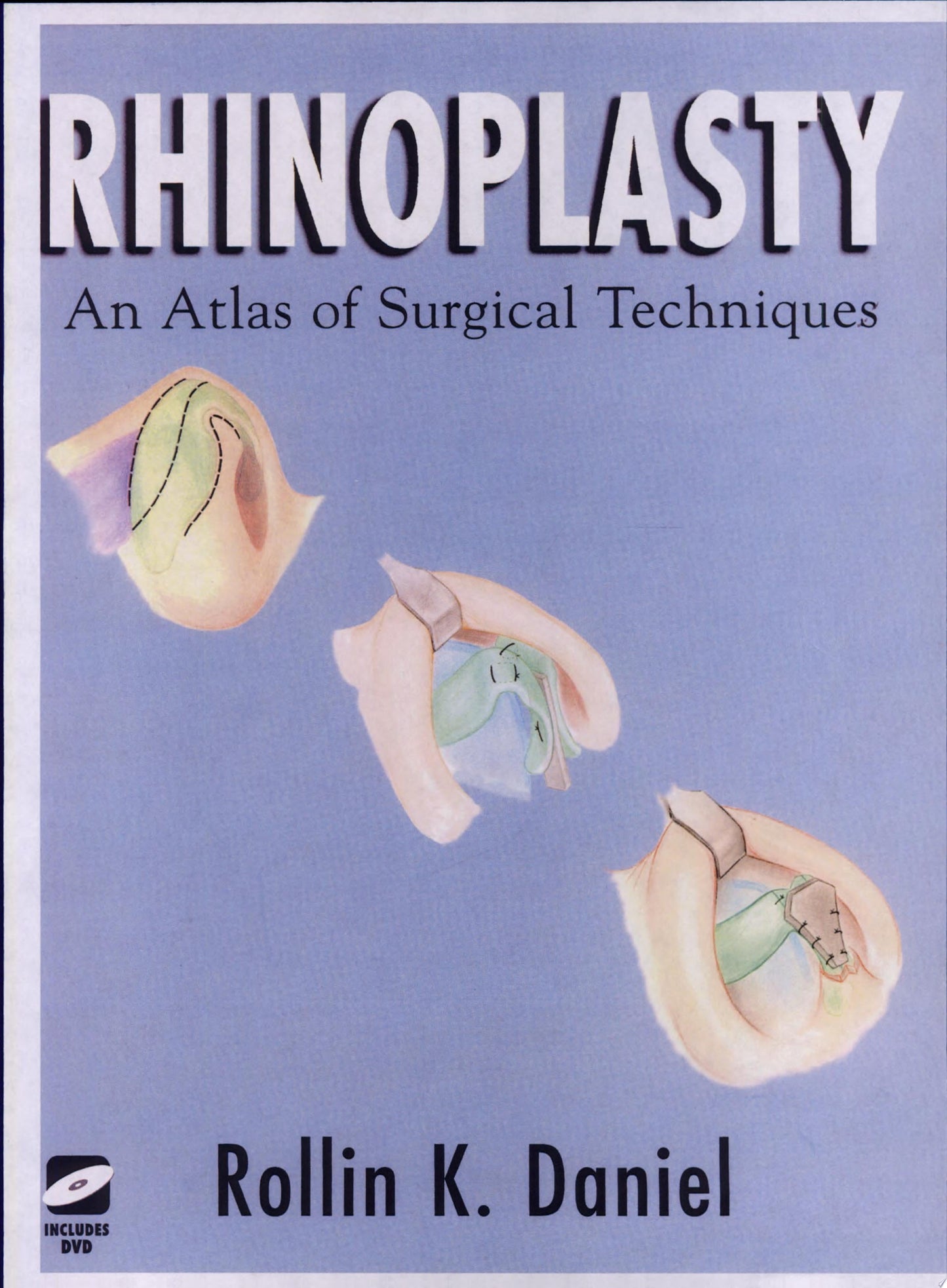 Rhinoplasty