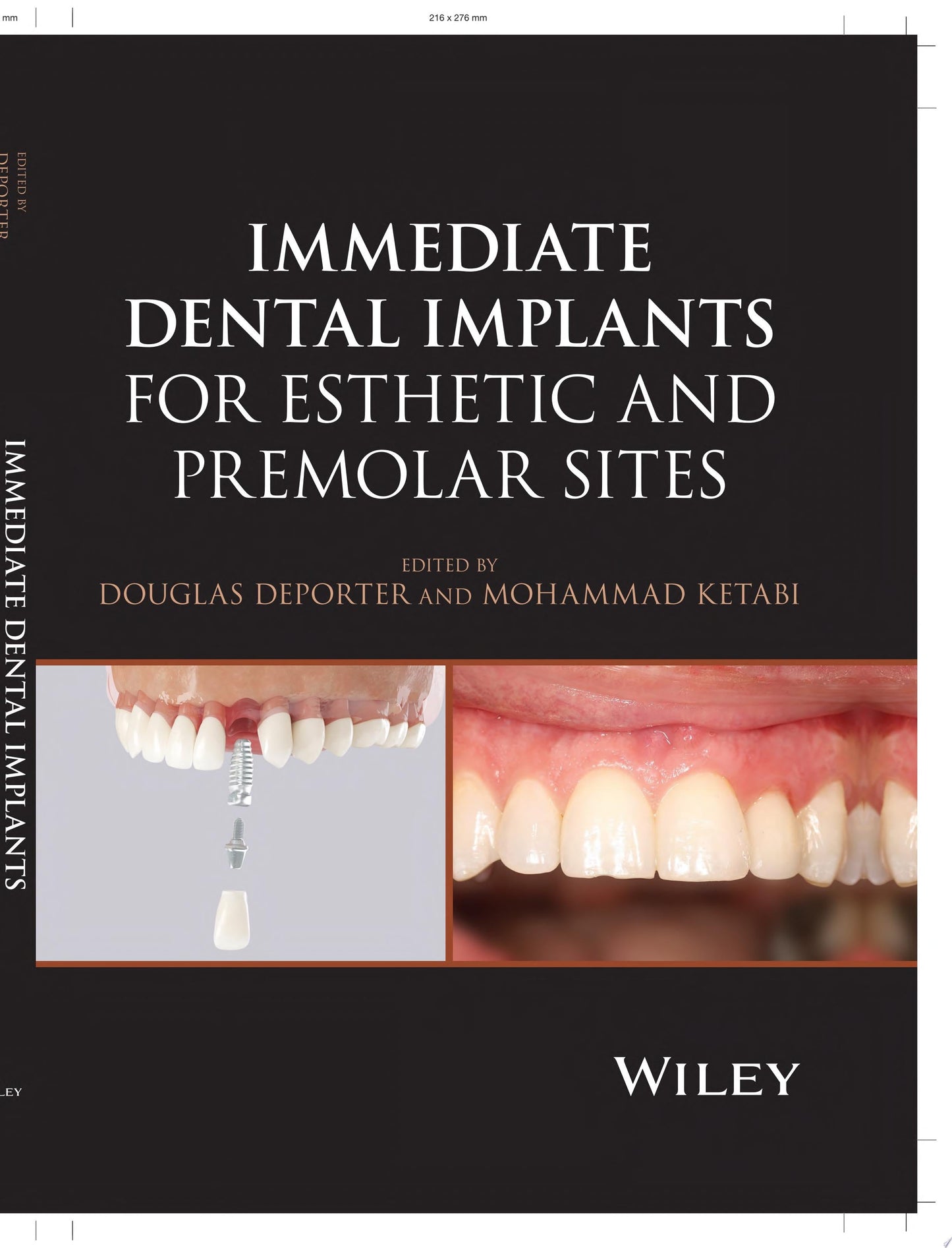 Immediate Dental Implants for Esthetic and Premolar Sites