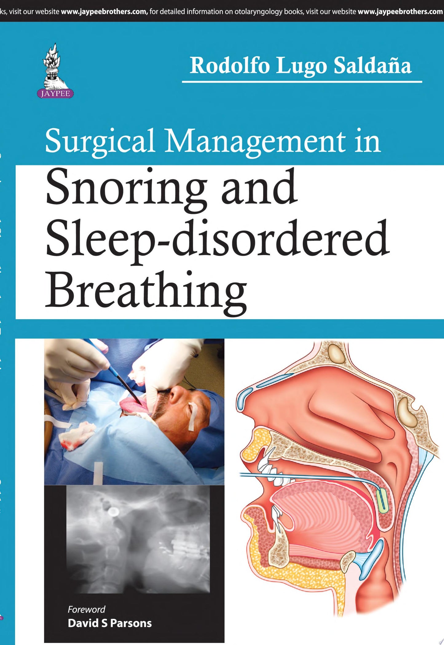 Surgical Management in Snoring and Sleep-disordered Breathing