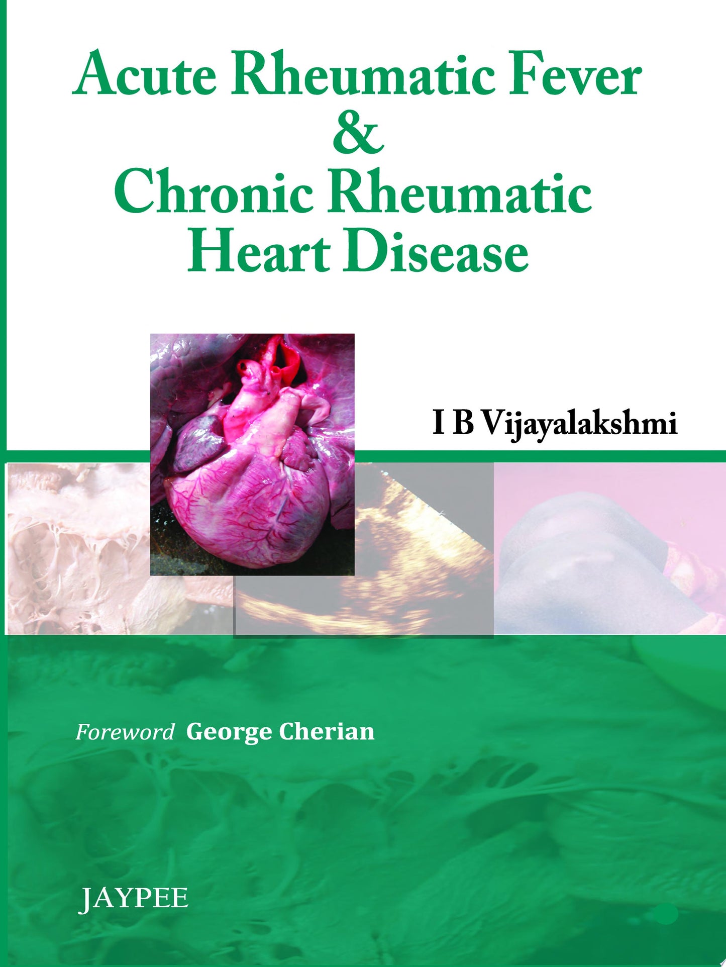 Acute Rheumatic Fever and Chronic Rheumatic Heart Disease