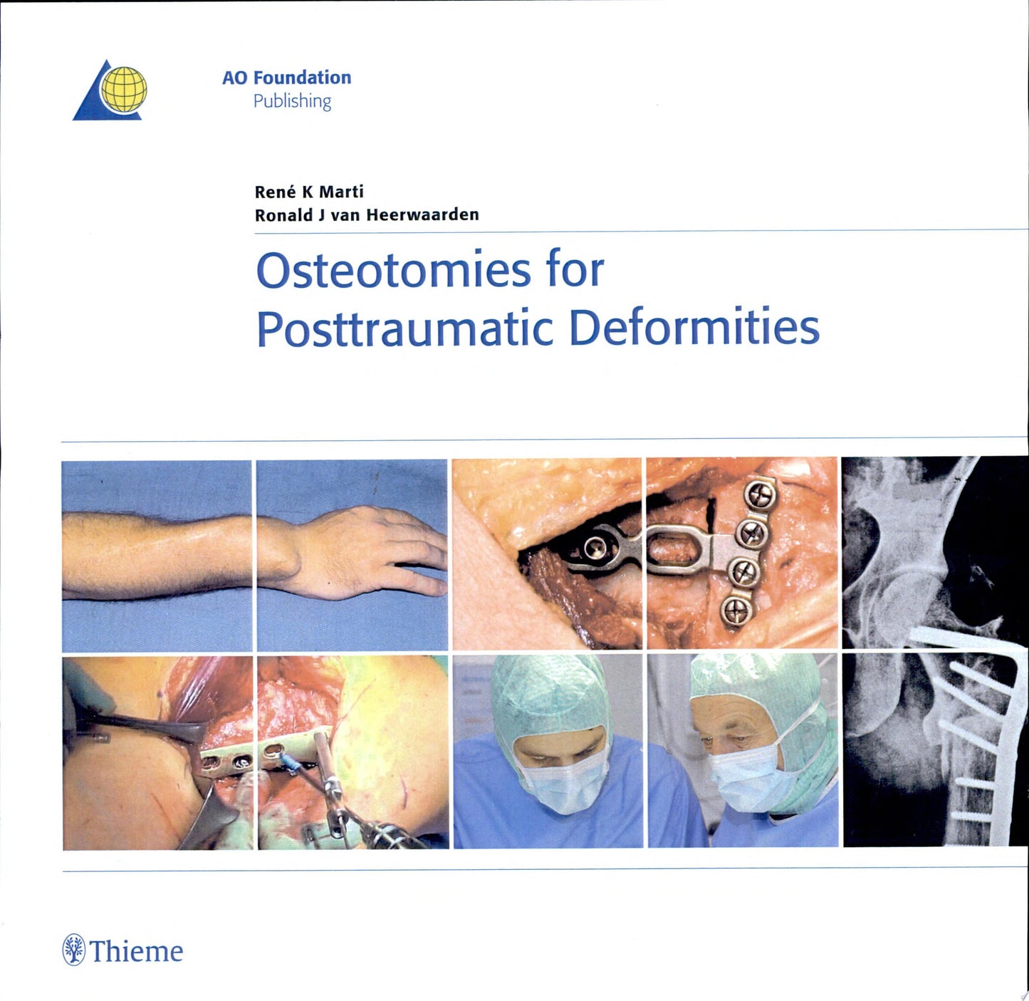 Osteotomies for Posttraumatic Deformities