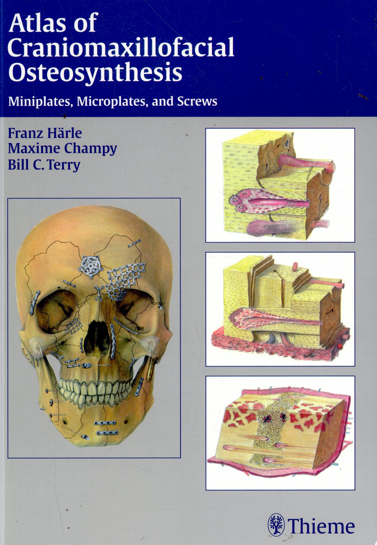 Atlas of Craniomaxillofacial Osteosynthesis: Microplates, Miniplates, and Screws, 2nd Edition