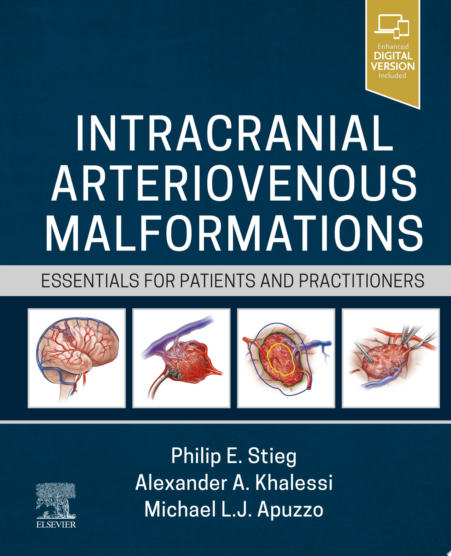 Intracranial Arteriovenous Malformations: Essentials for Patients and Practitioners