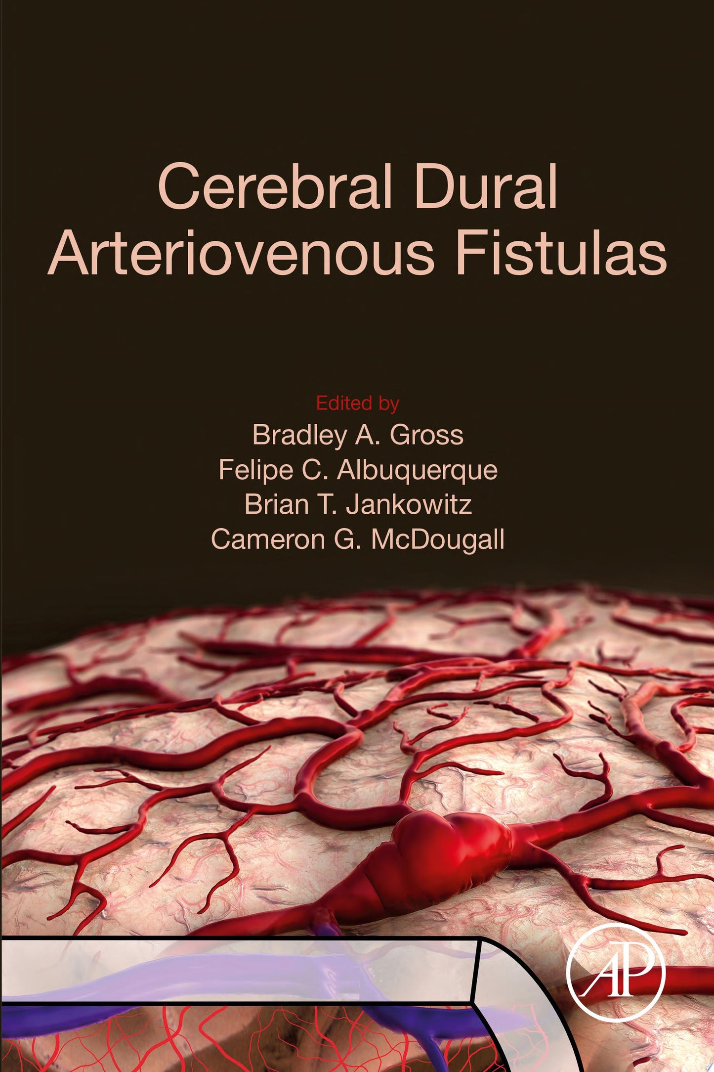 Cerebral Dural Arteriovenous Fistulas