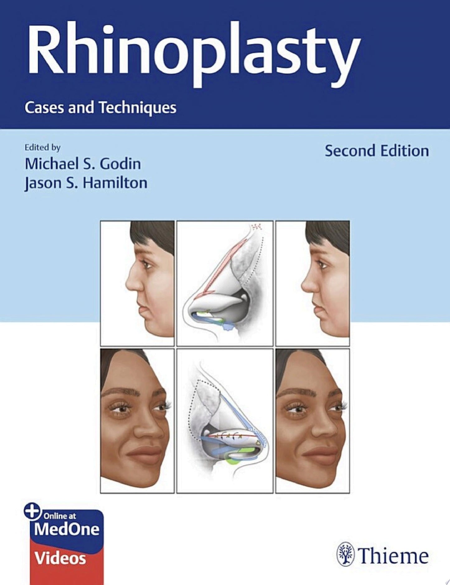 Rhinoplasty: Cases and Techniques 2e (PDF+Videos)
