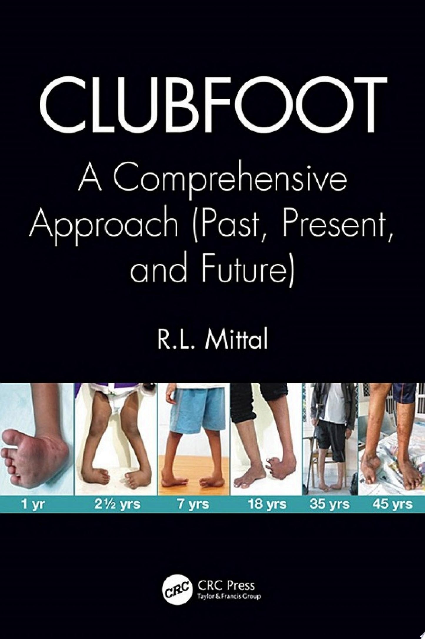 Clubfoot: A Comprehensive Approach