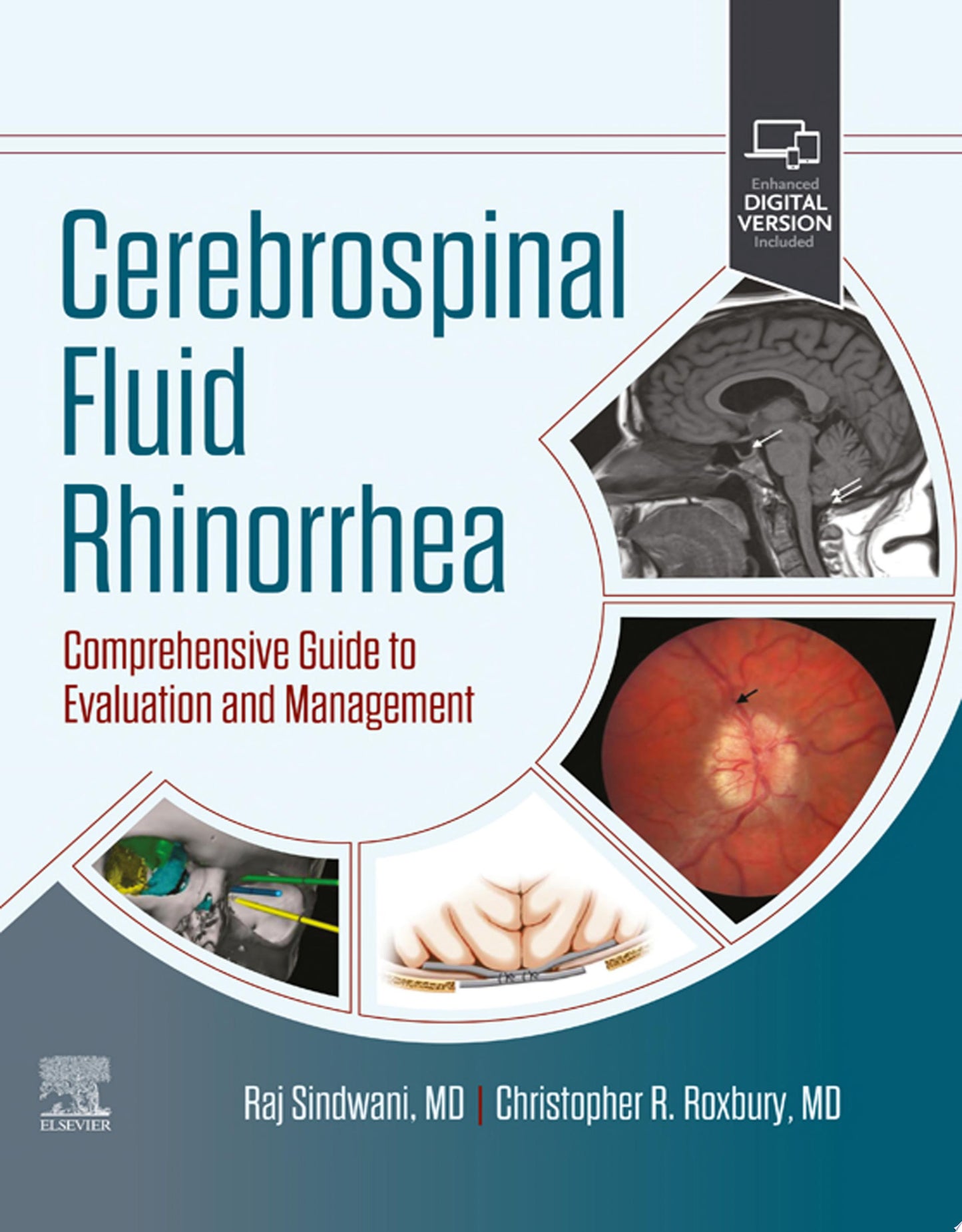 Cerebrospinal Fluid Rhinorrhea: Comprehensive Guide to Evaluation and Management