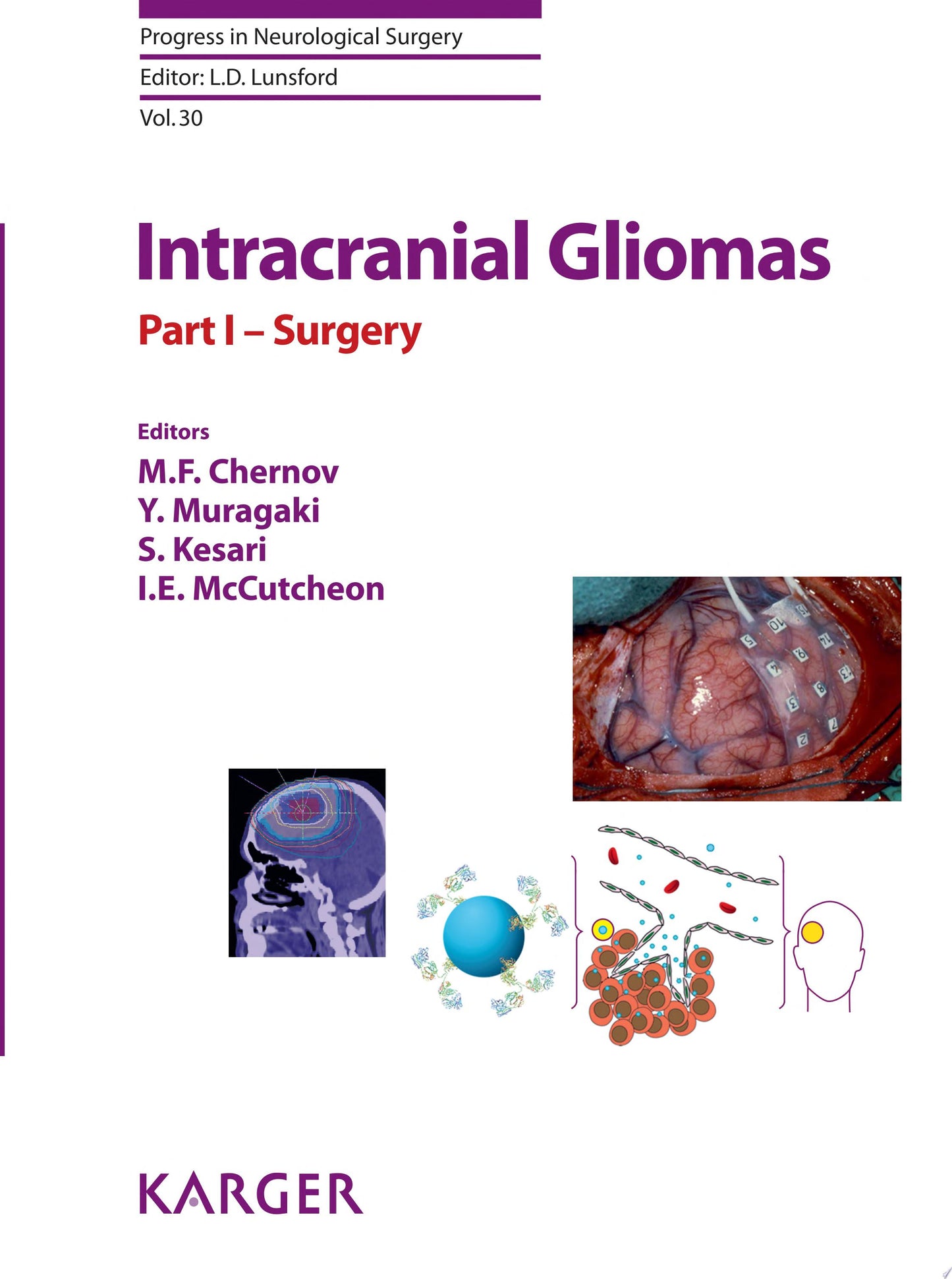 Intracranial Gliomas Part I – Surgery 1st Edition
