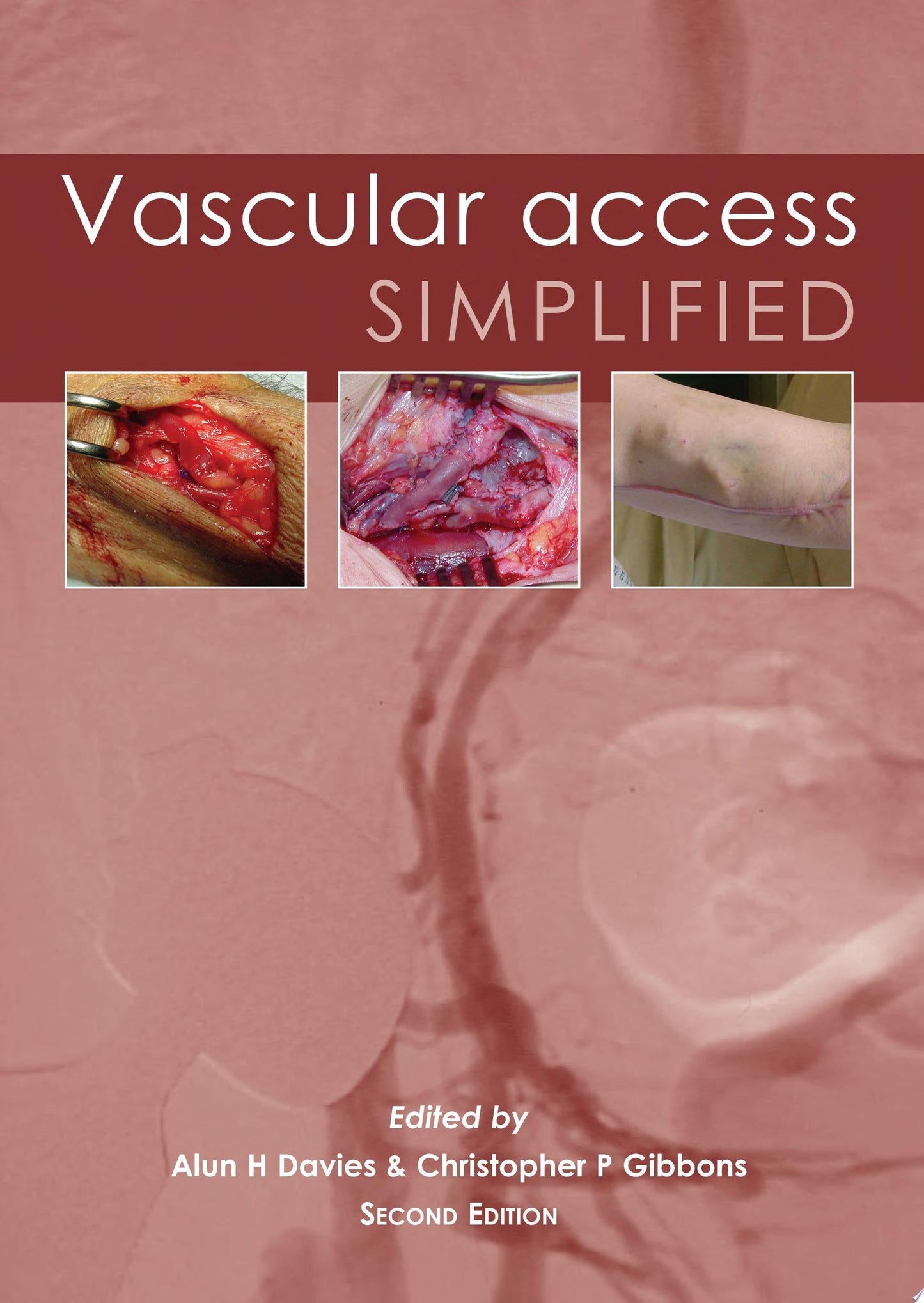 Vascular Access Simplified; second edition