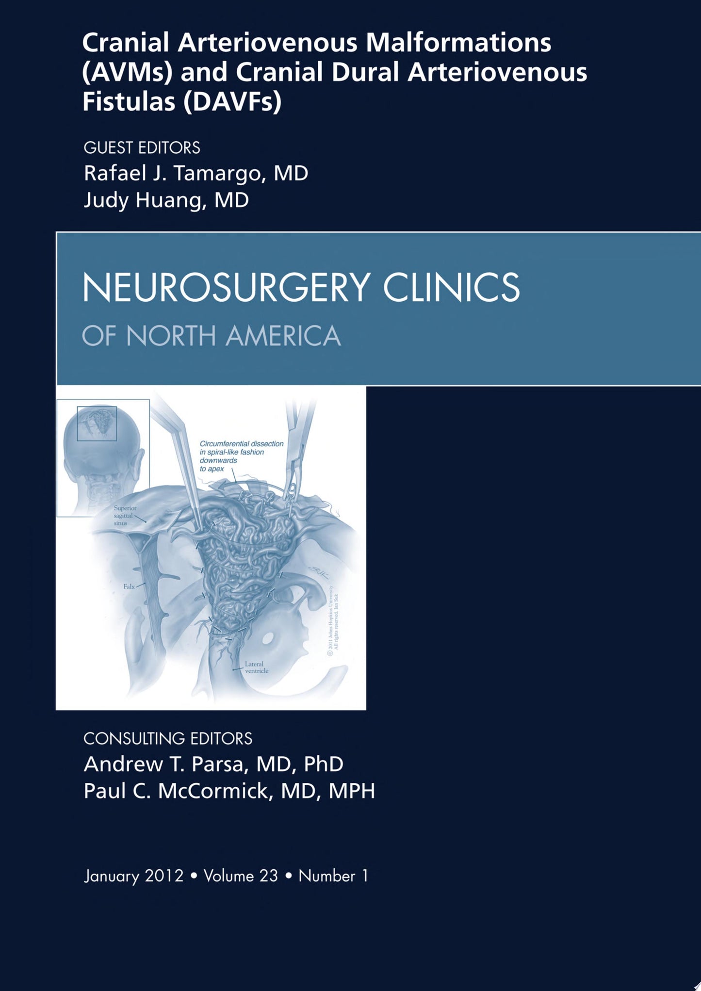Cranial Arteriovenous Malformations and Cranial Dural Arteriovenous Fistulas , An Issue of Neurosurgery Clinics