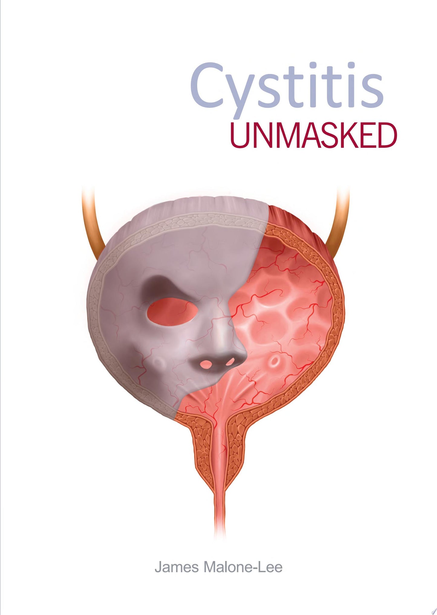 Cystitis unmasked