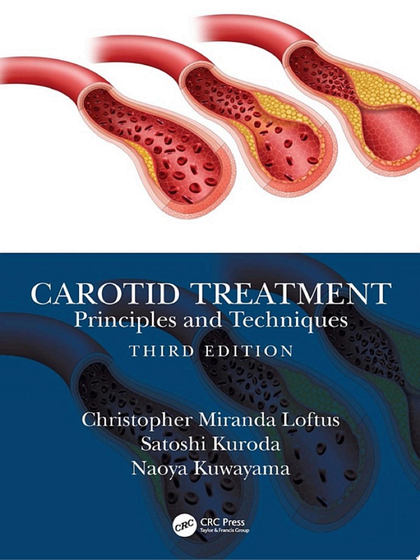 Carotid Treatment: Principles and Techniques, 3rd Edition