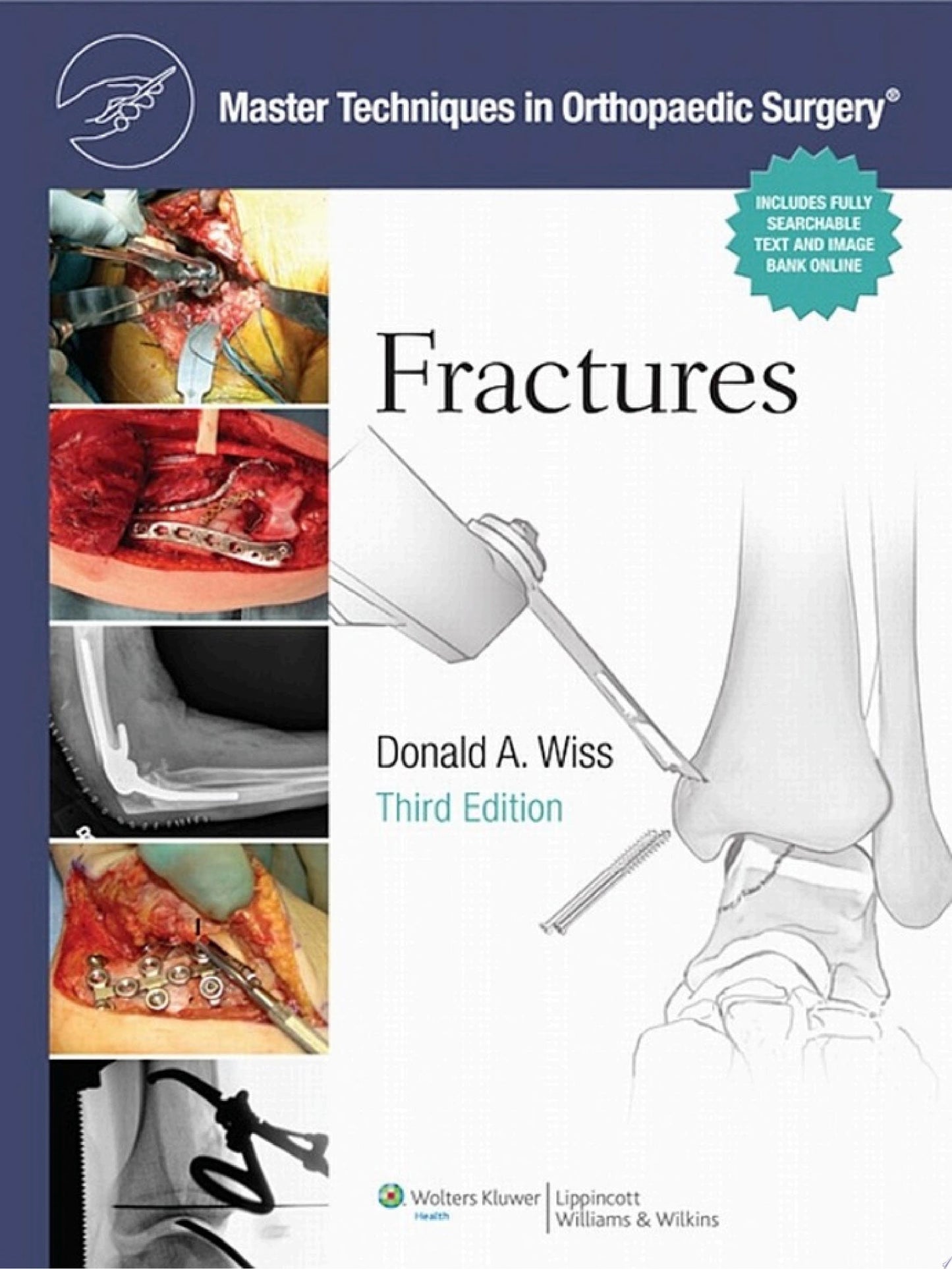 Master Techniques in Orthopaedic Surgery: Fractures, 3rd Edition