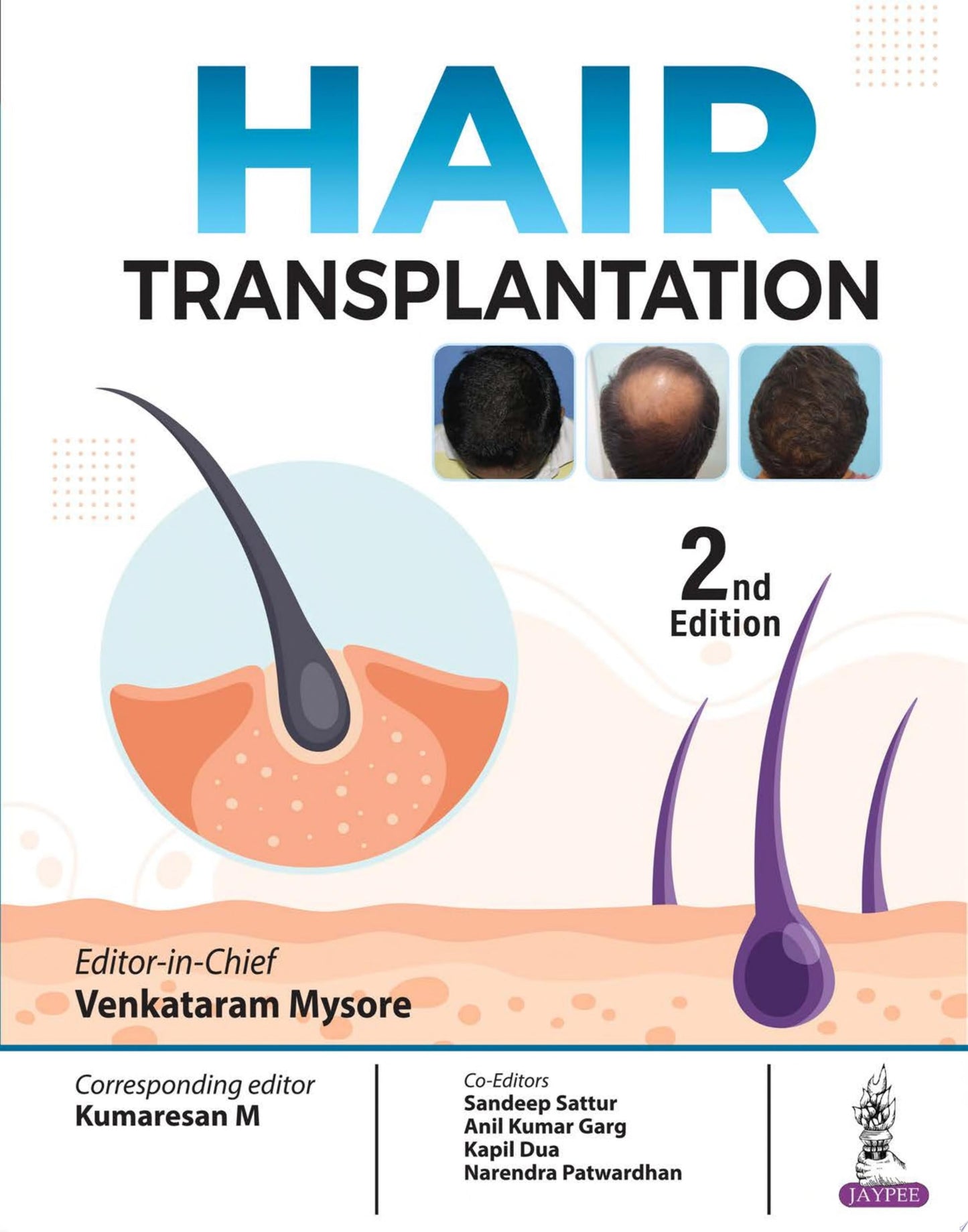 Hair Transplantation, 5ed