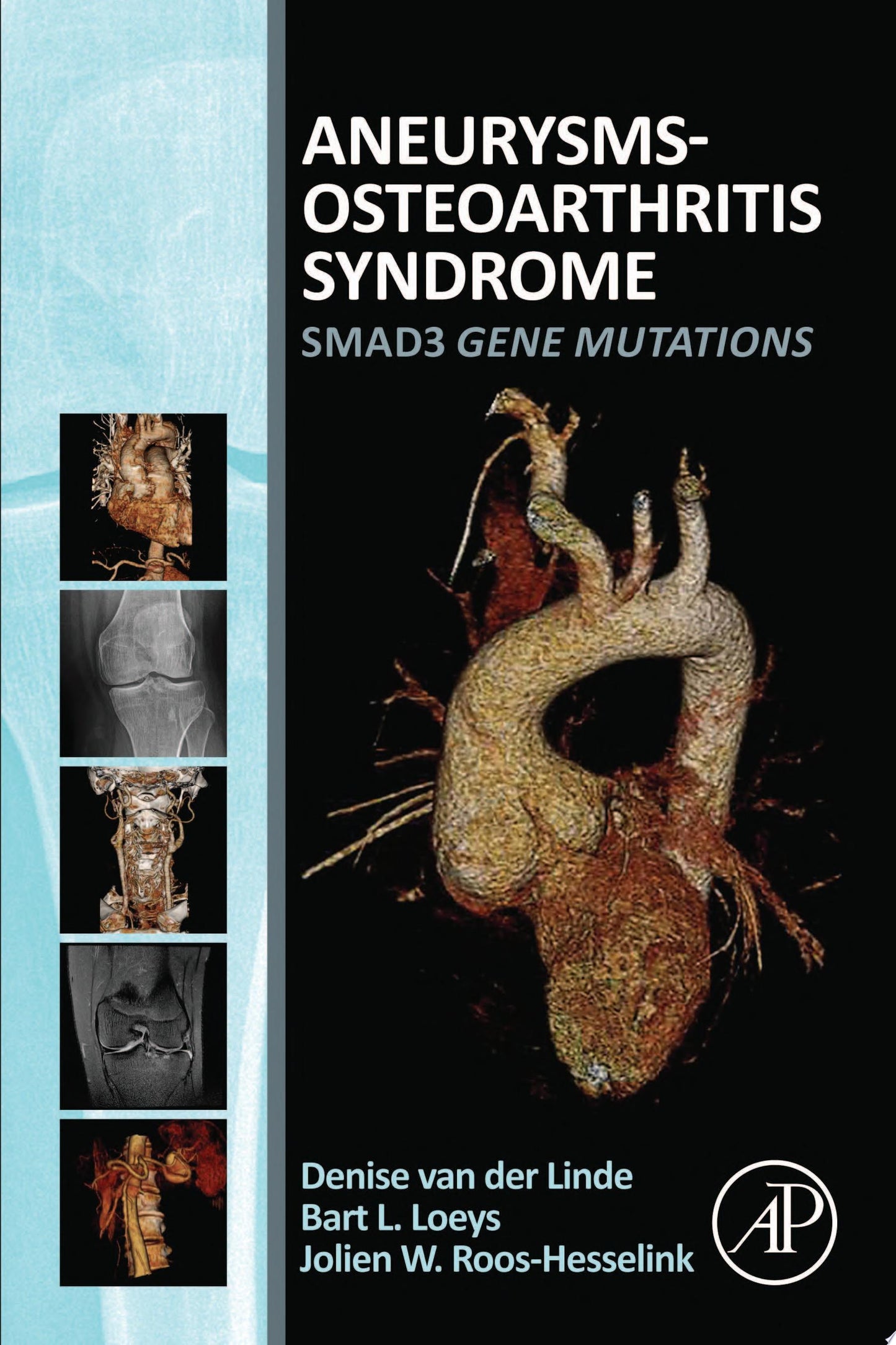 Aneurysms-Osteoarthritis Syndrome: SMAD3 Gene Mutations