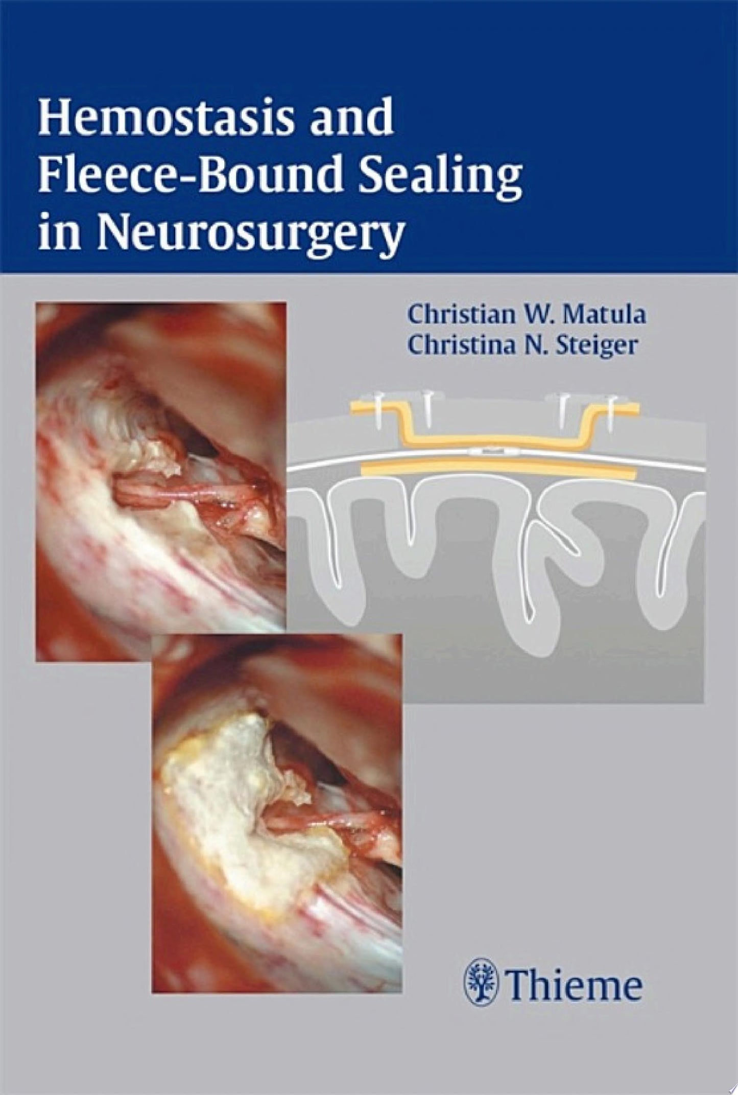Hemostasis and Fleece-Bound Sealing in Neurosurgery