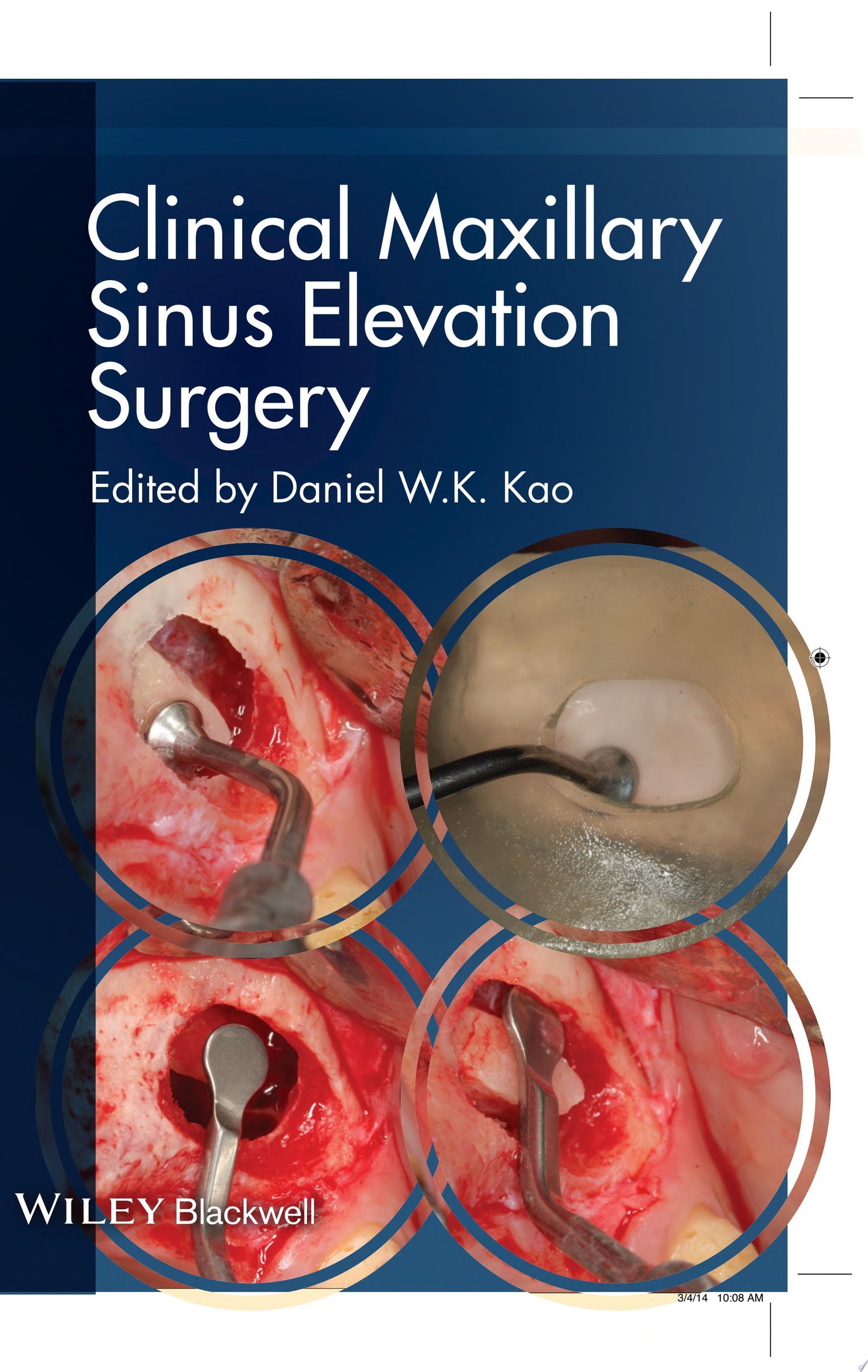 Clinical Maxillary Sinus Elevation Surgery
