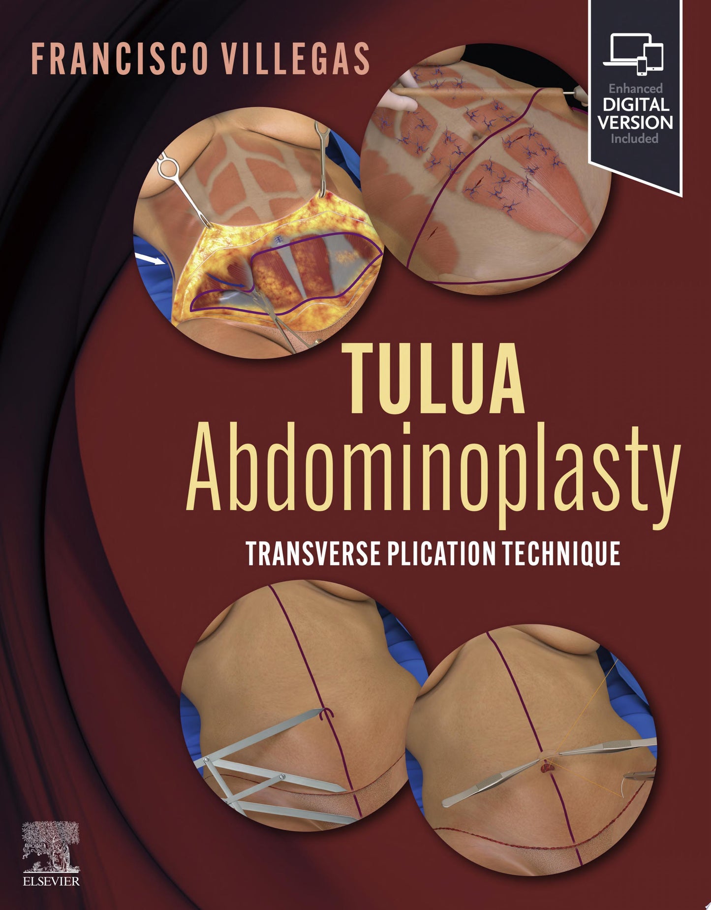 TULUA Abdominoplasty: Transverse Plication Technique
