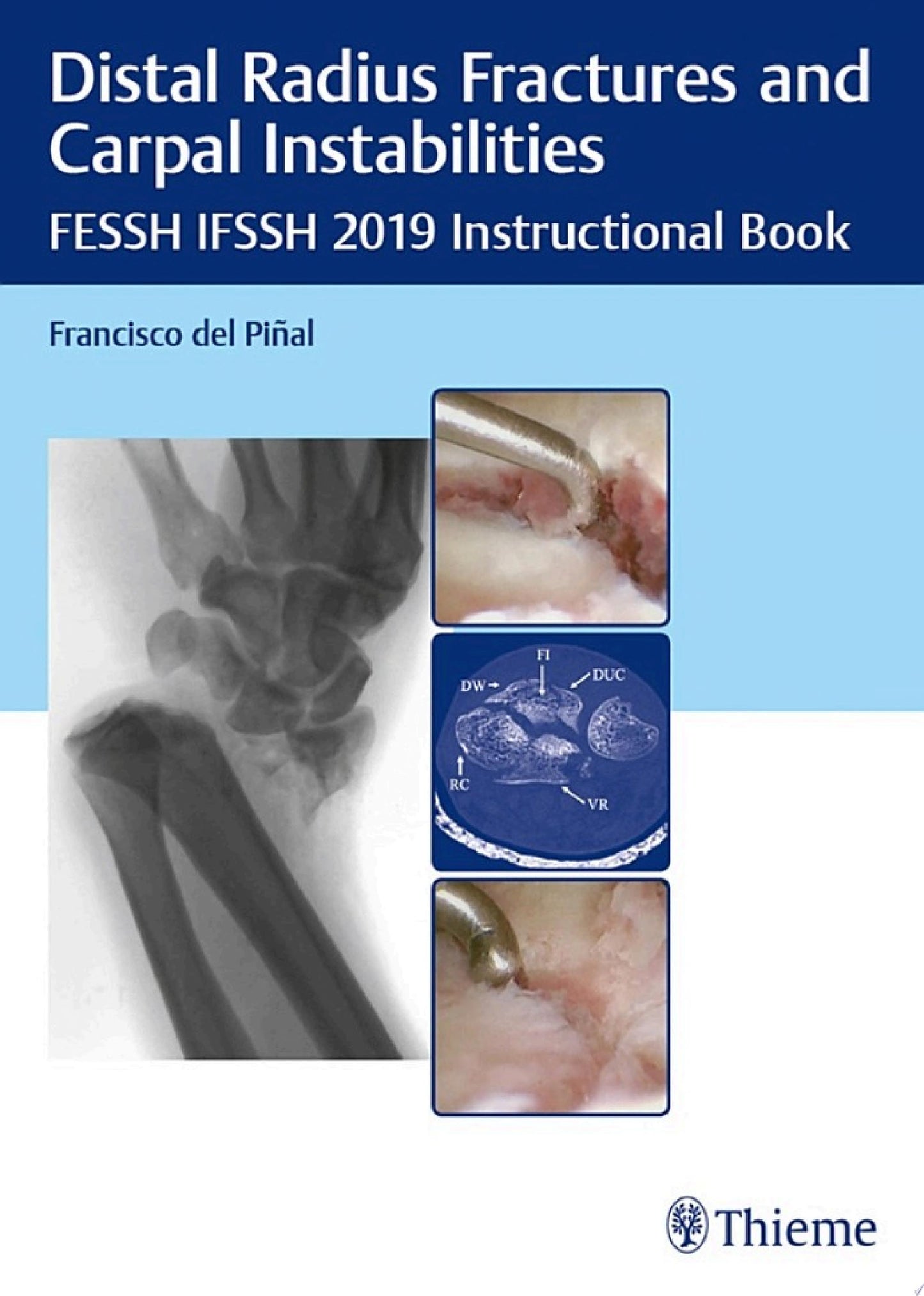 Distal Radius Fractures and Carpal Instabilities: FESSH IFSSH 2019 Instructional Book