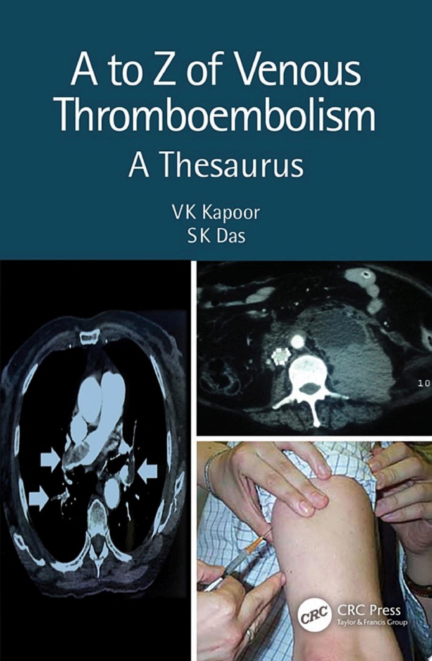 A to Z of Venous Thromboembolism: A Thesaurus