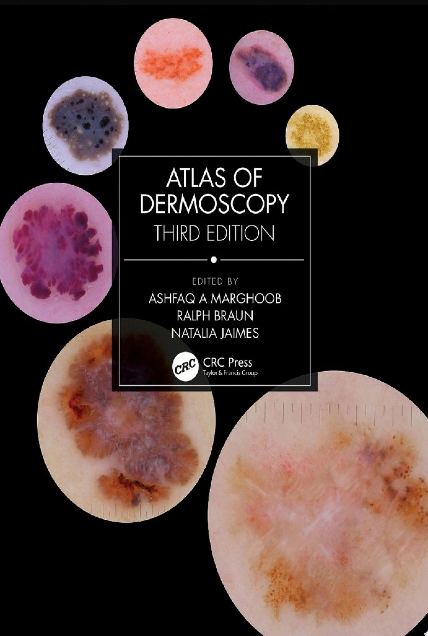 Dermoscopy of the Hair and Nails, 3rd Edition
