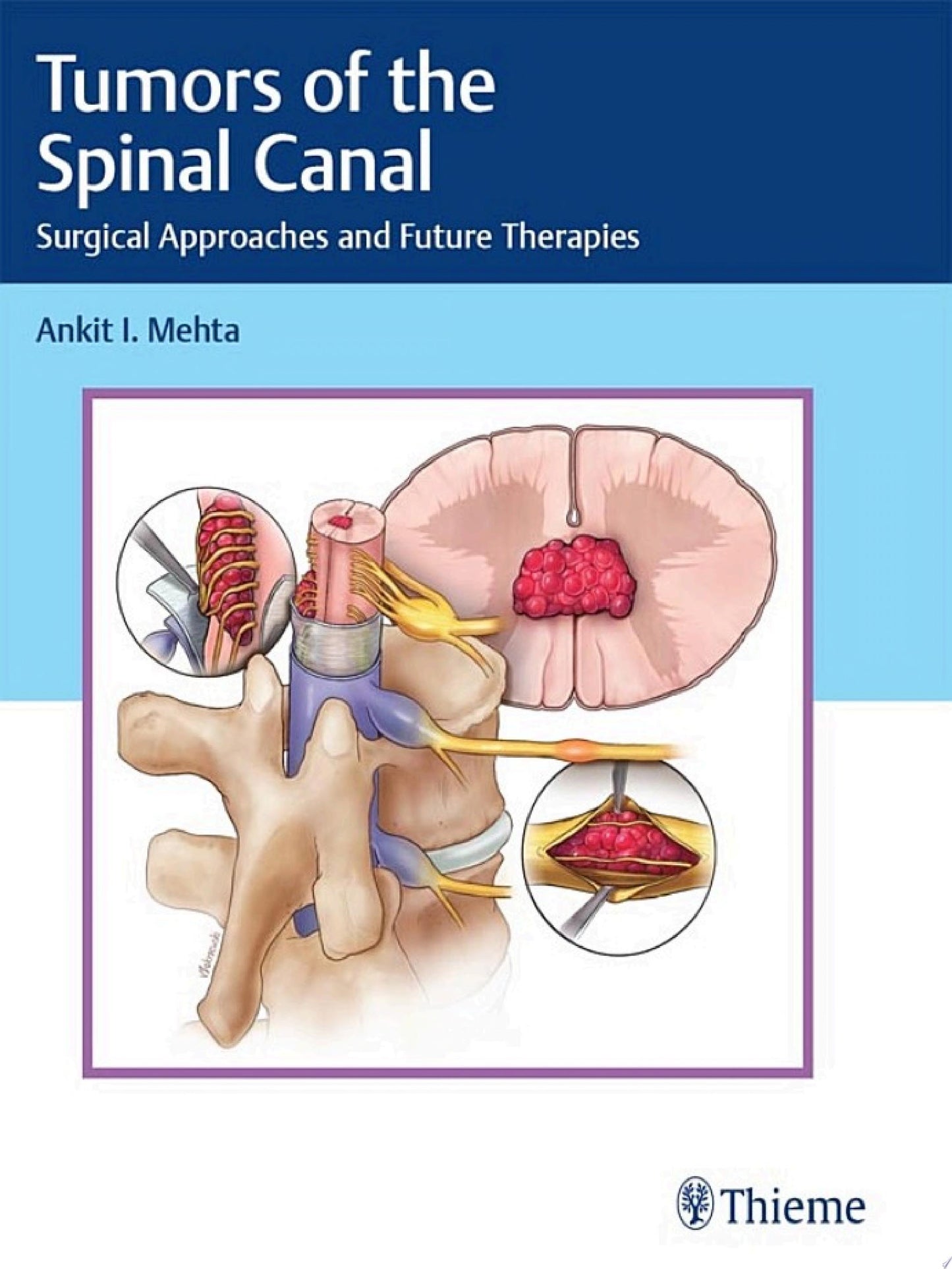 Tumors of the Spinal Canal: Surgical Approaches and Future Therapies