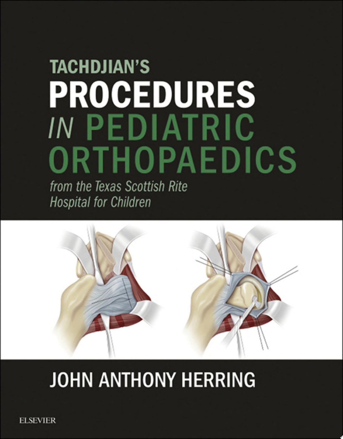 Tachdjian’s Procedures in Pediatric Orthopaedics: From the Texas Scottish Rite Hospital for Children