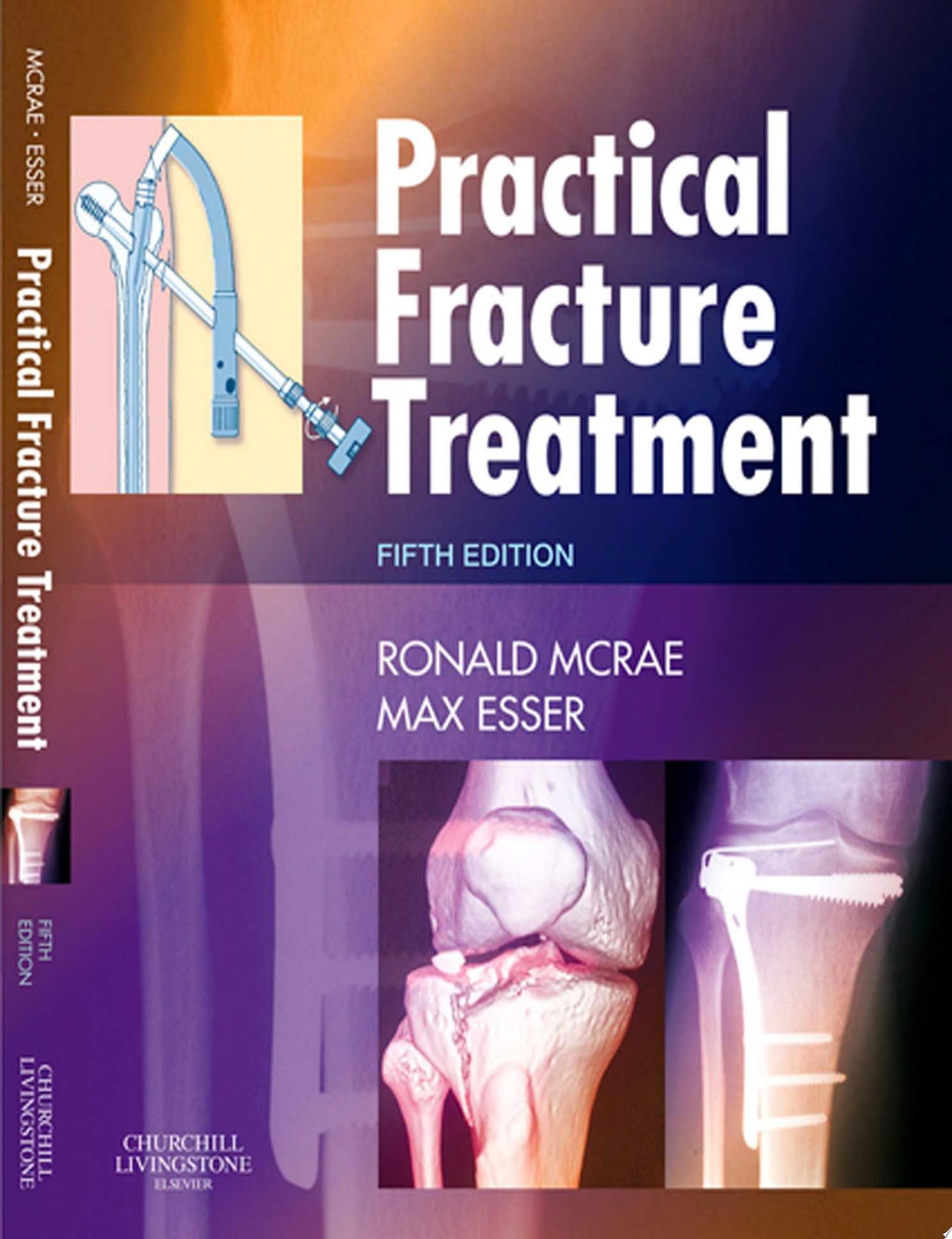 Practical Fracture Treatment, 5e