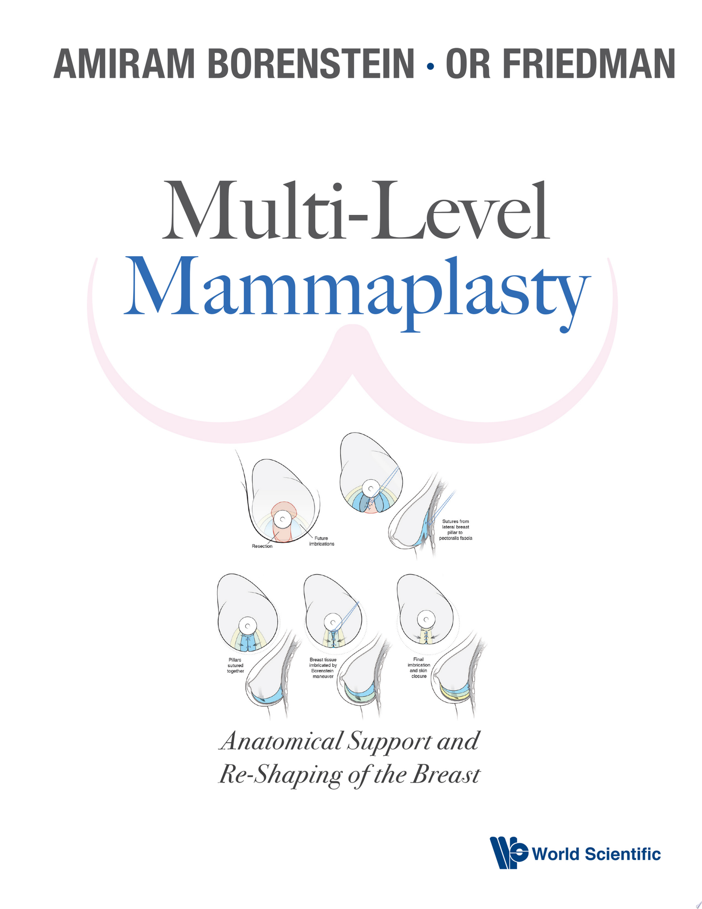 Multi-Level Mammaplasty: Anatomical Support and Re-Shaping of the Breast