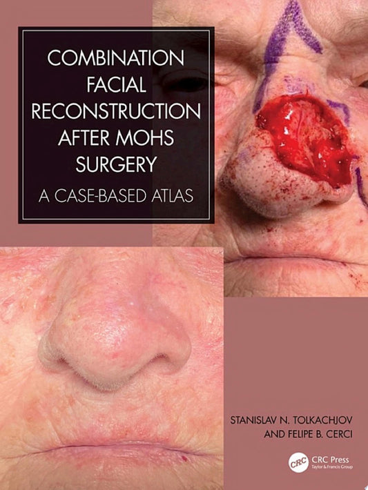 Combination Facial Reconstruction after Mohs Surgery