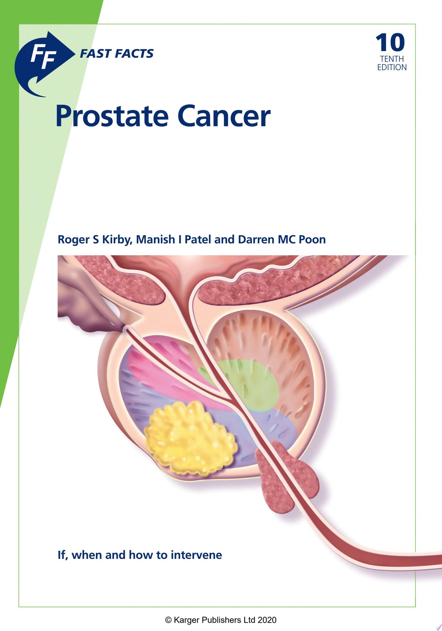 Fast Facts: Prostate Cancer: If, when and how to intervene