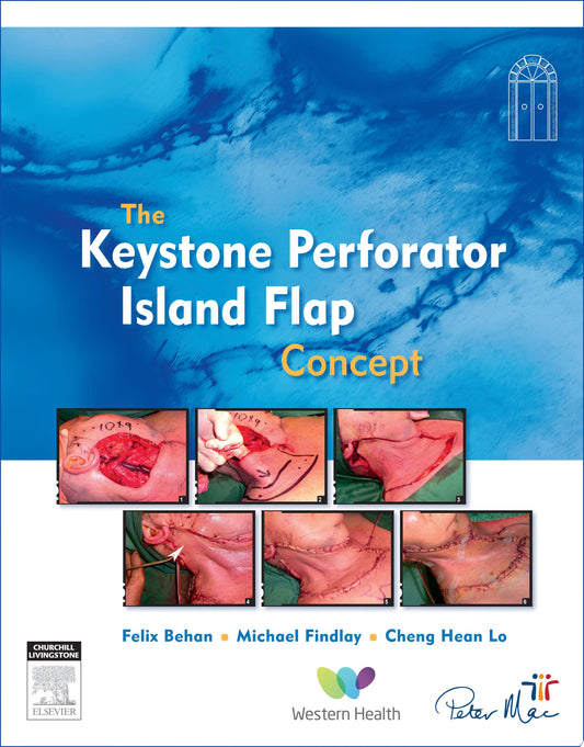 The Keystone Perforator Island Flap Concept