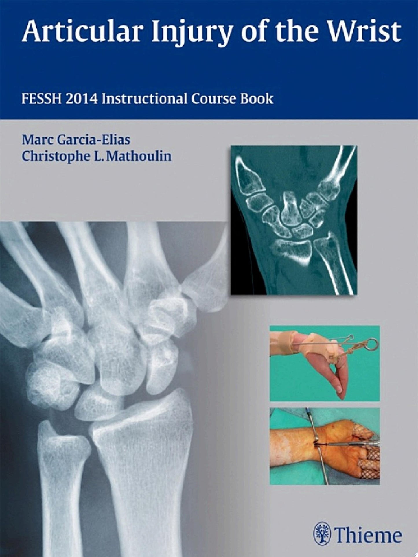 Articular Injury of the Wrist: FESSH 2014 Instructional Course Book