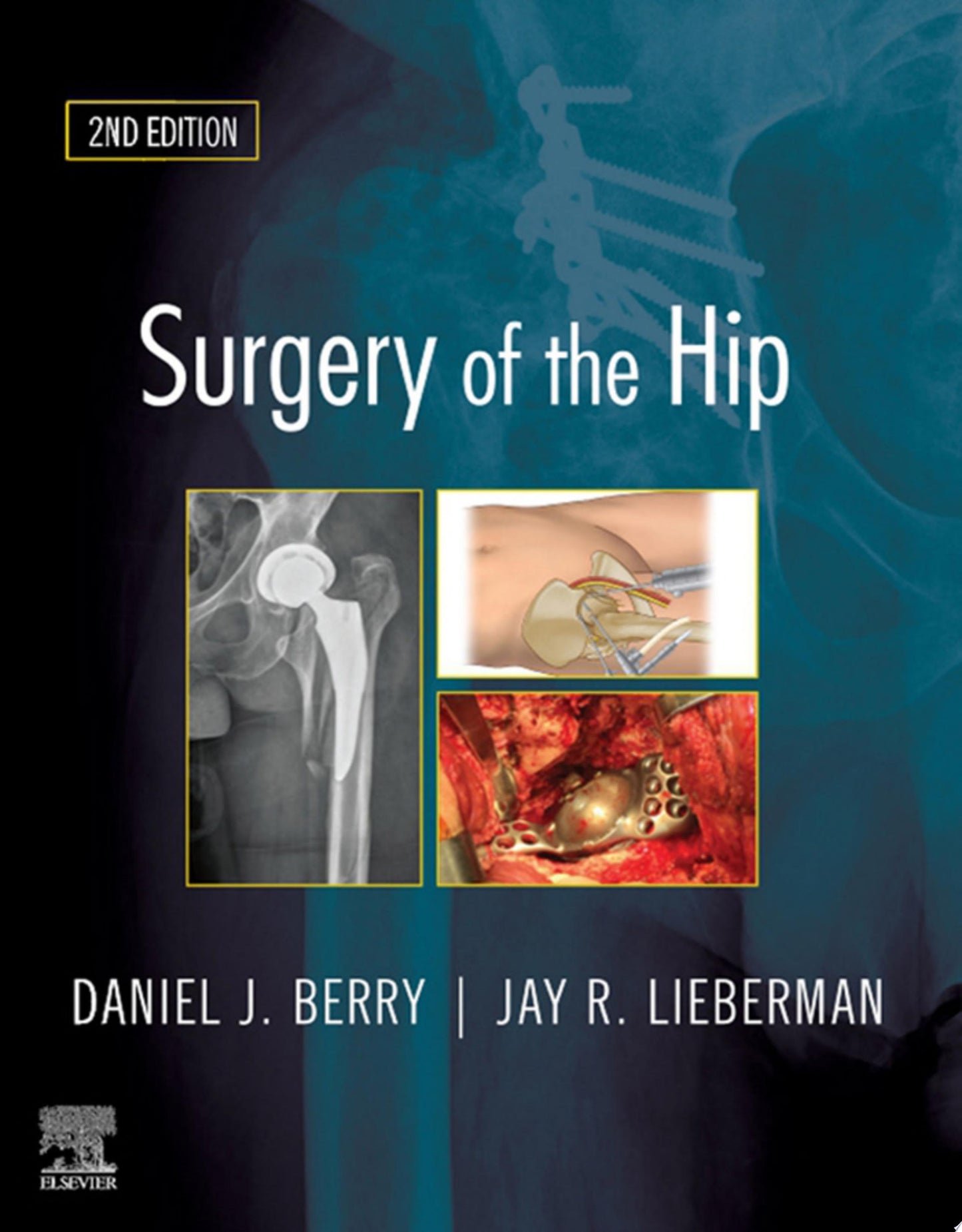 Surgery of the Hip, 2nd Edition