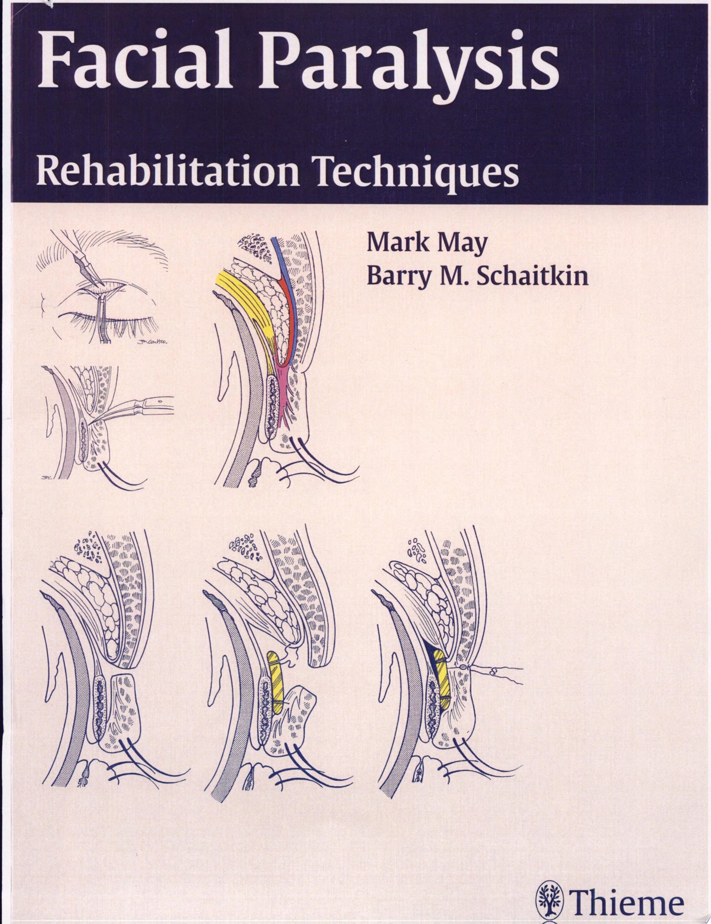 Facial Paralysis: Rehabilitation Techniques