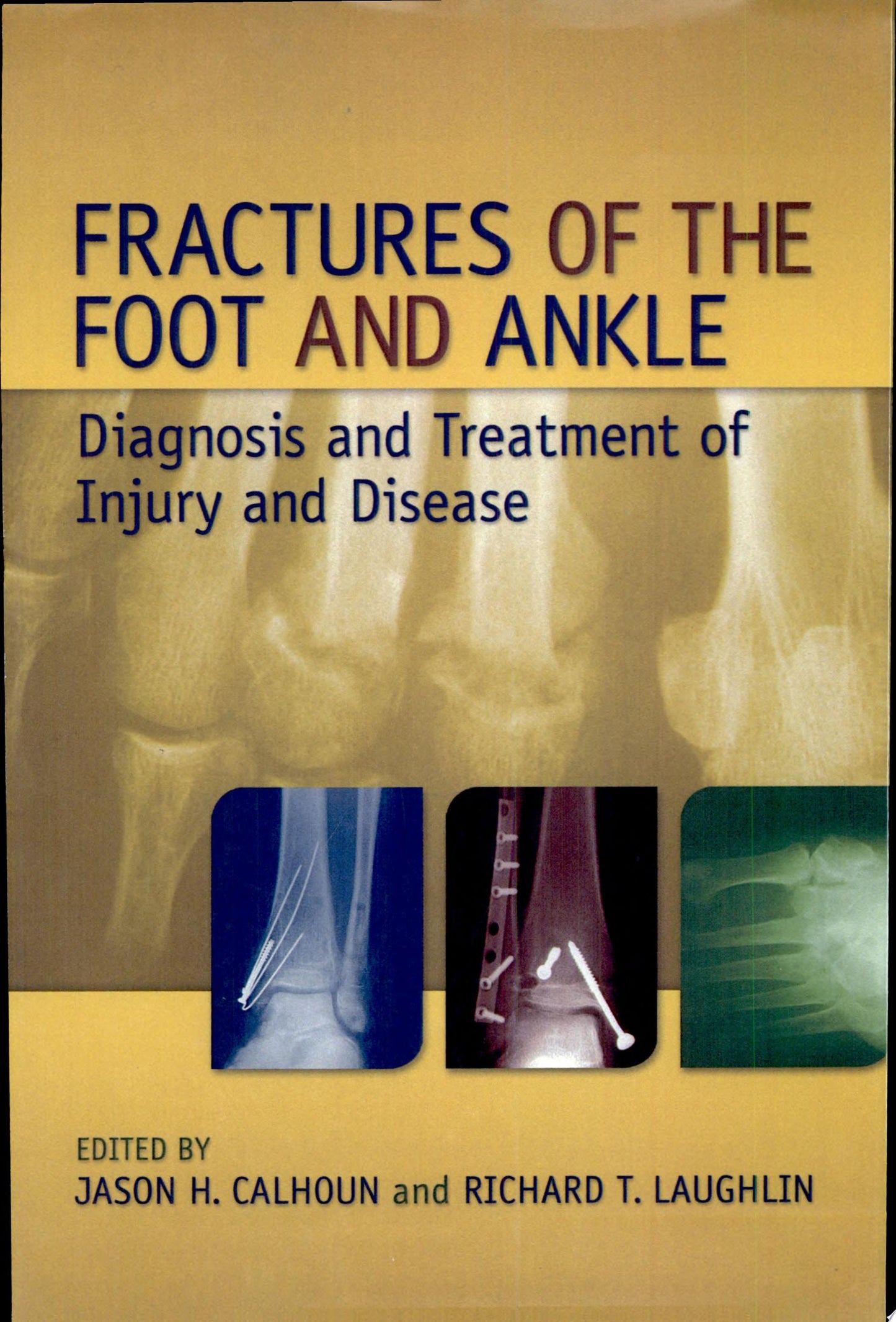 Fractures of the Foot and Ankle